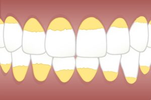 manchas en los dientes