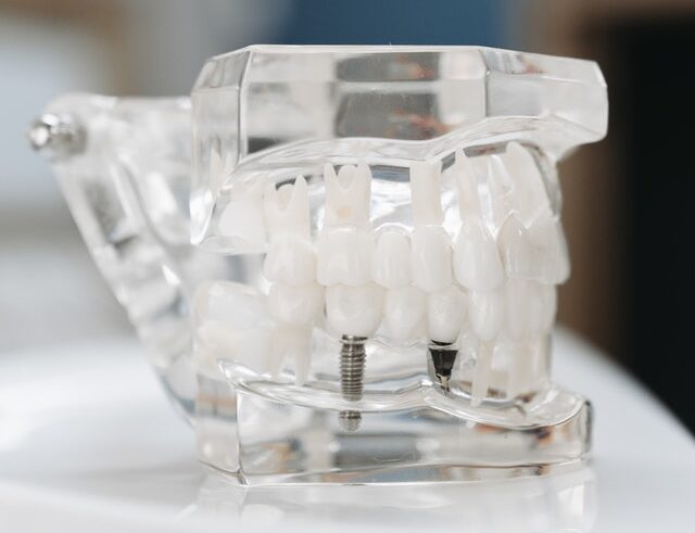 implantes dentales (2)