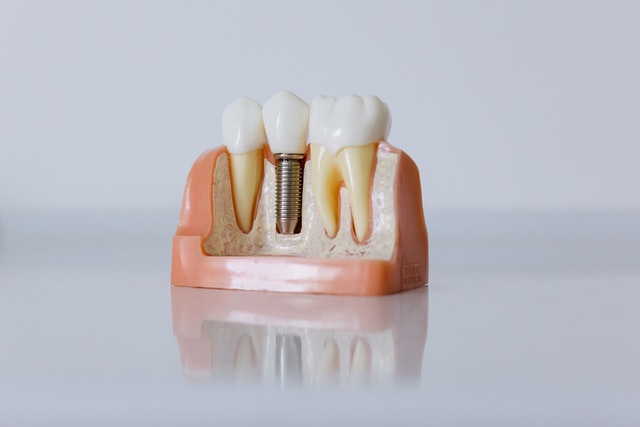 implantes dentales en salamanca (2)