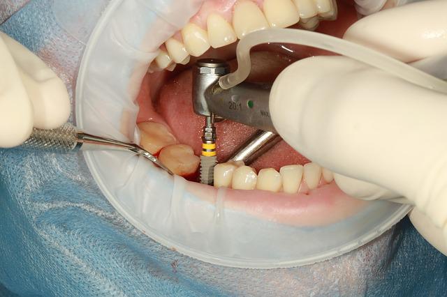implantes dentales (3)