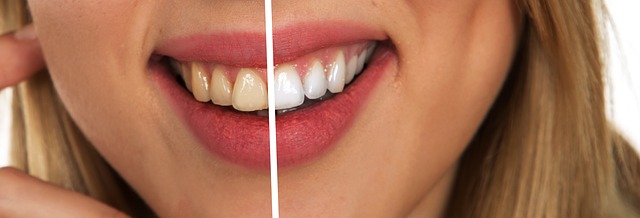 Tratamiento para blanquear los dientes